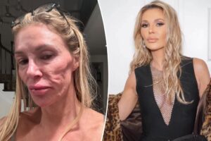 Parasite possible à l'origine de déformation faciale, Brandi Glanville.